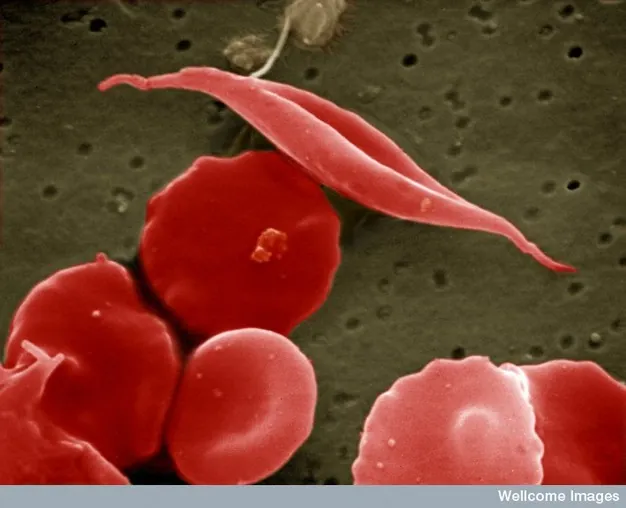 Obrazek przedstawiający komórki krwi w anemii sierpowatej
